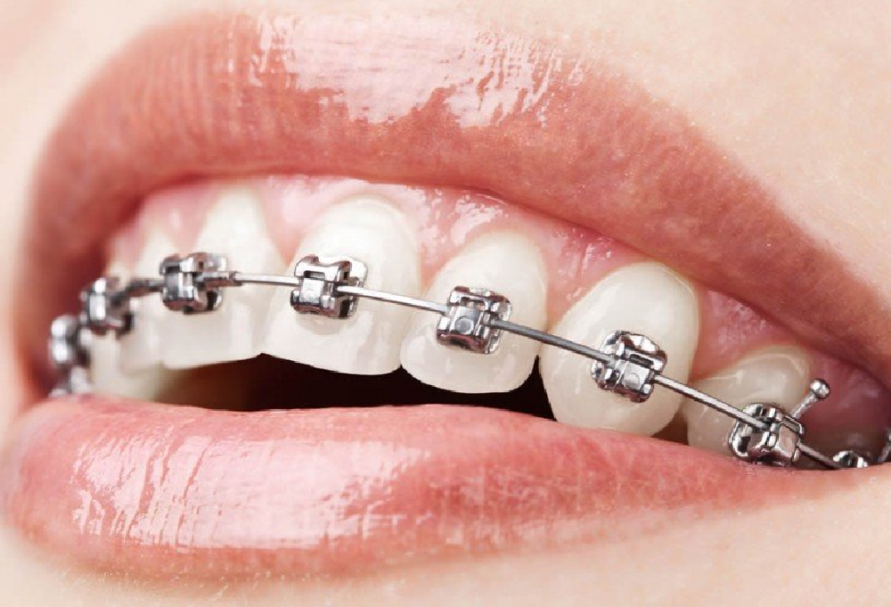 Braces